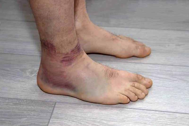 Jak długo boli skręcona kostka? Poznaj czas leczenia i objawy