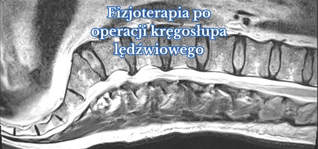 Czy fizjoterapia pomaga na kręgosłup? Odkryj skuteczne metody leczenia